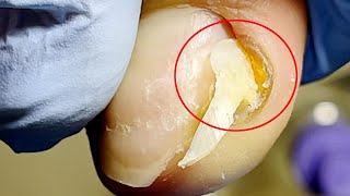 Extremely long ingrown toenails,The patient has not had a pedicure for 4 months